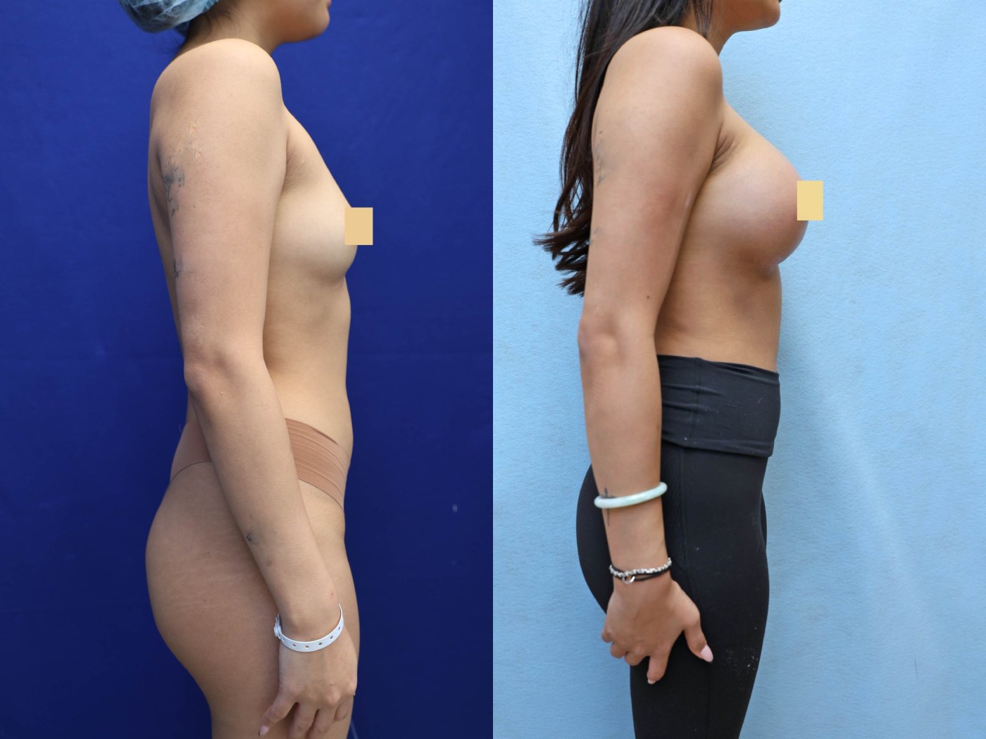 Breast Augmentation Before & After Photos
