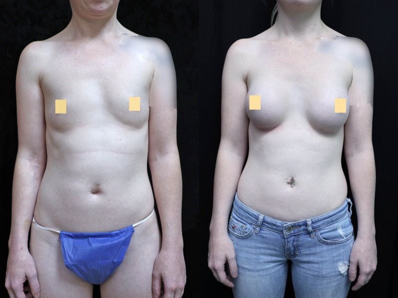 Breast Augmentation Before & After Photos
