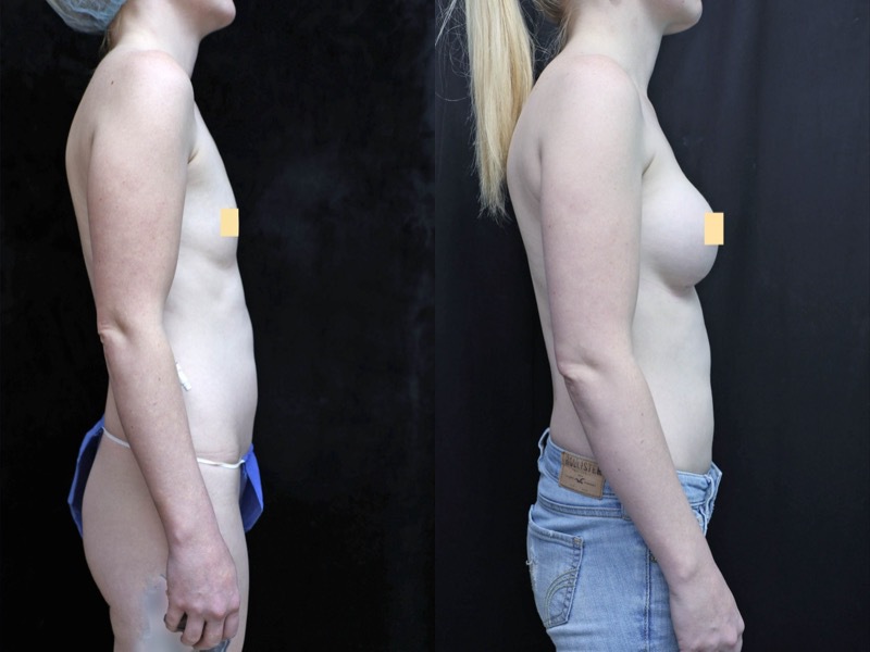 Breast Augmentation Before & After Photos