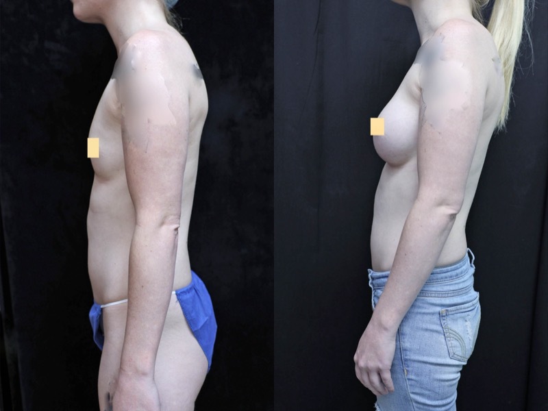 Breast Augmentation Before & After Photos