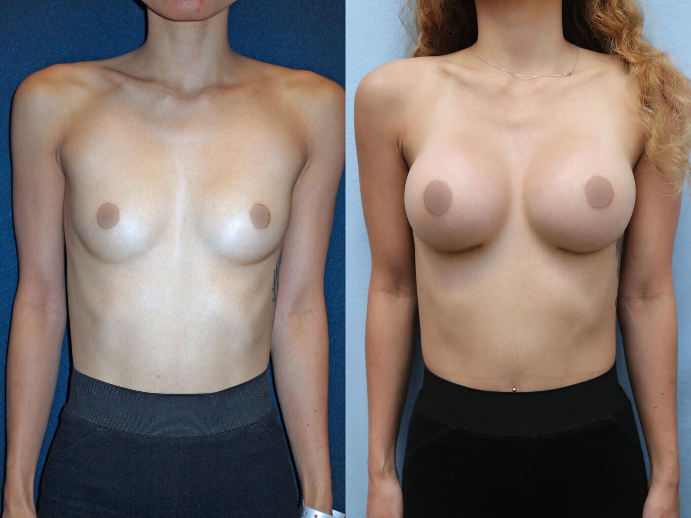 Breast Augmentation Before & After Photos