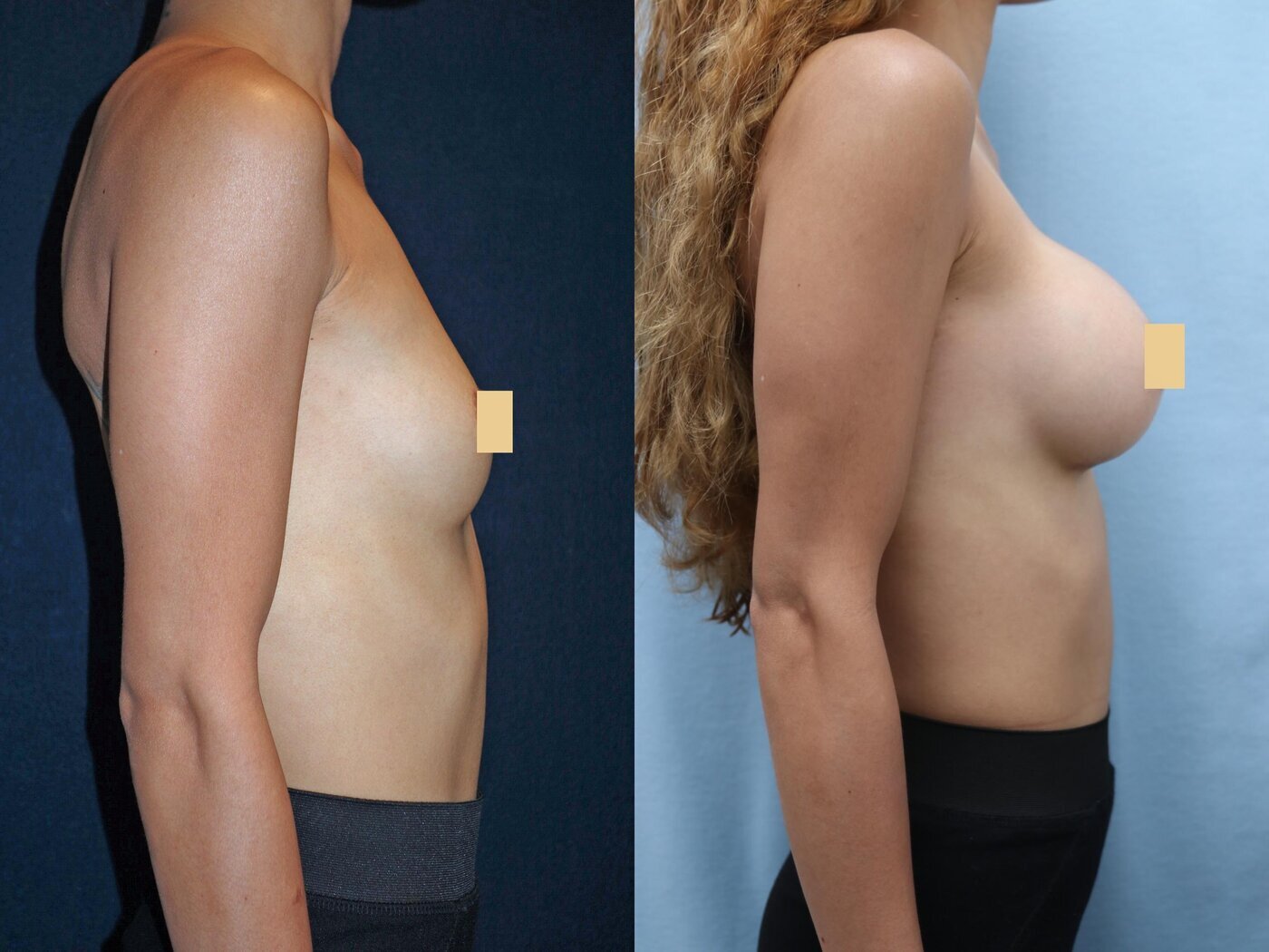 Breast Augmentation Before & After Photos