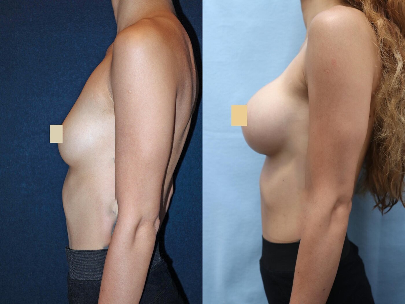Breast Augmentation Before & After Photos