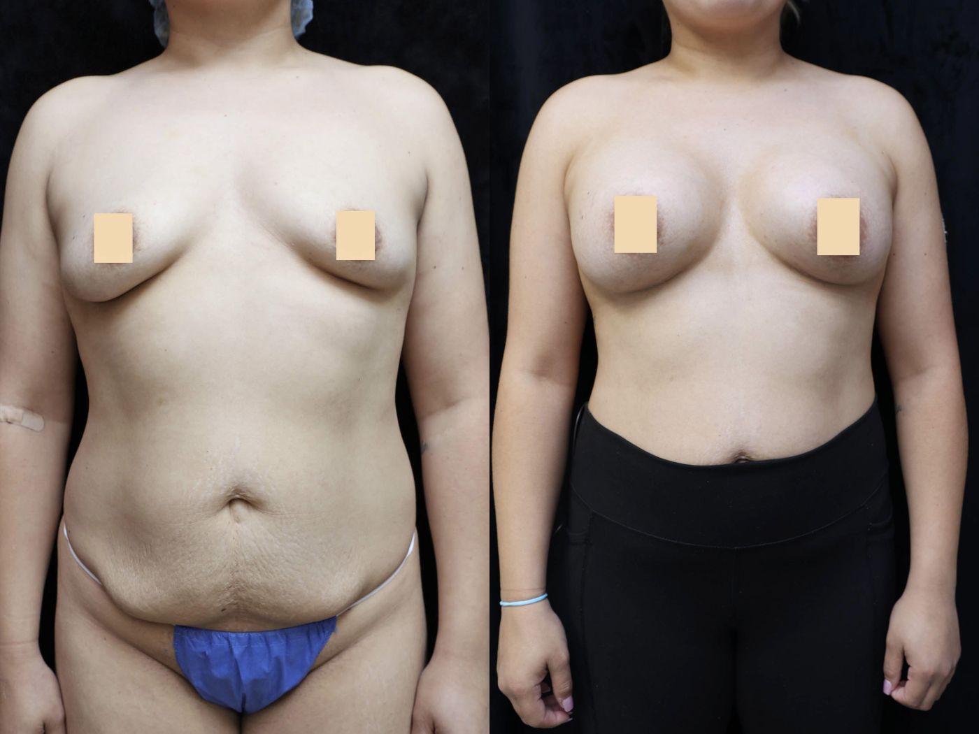 Breast Augmentation Before & After Photos