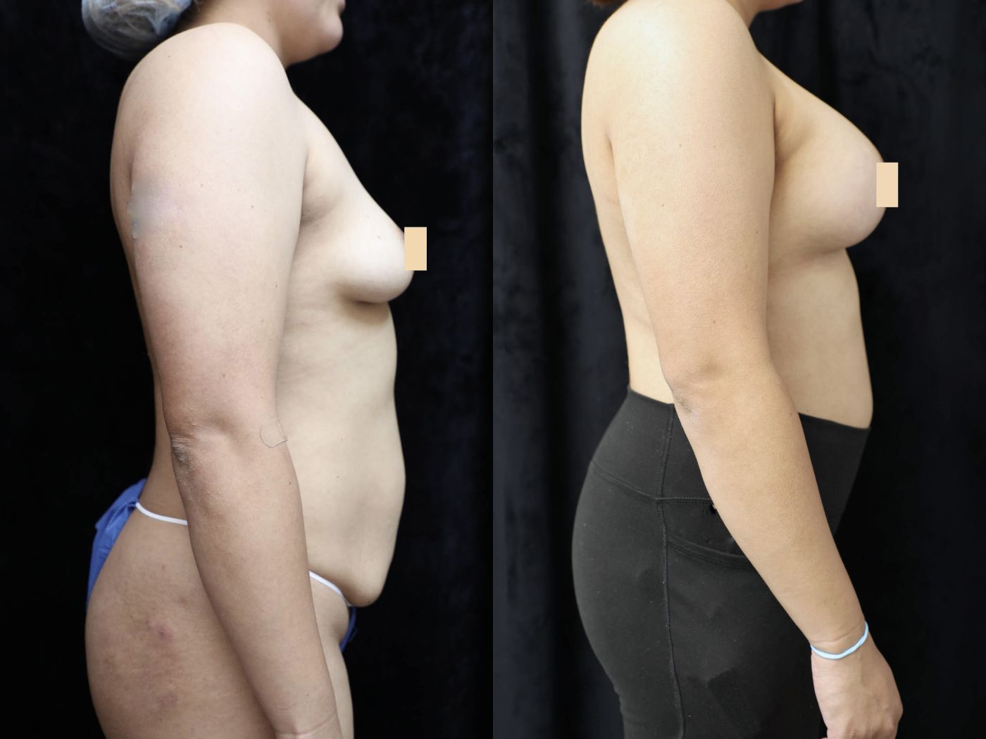 Breast Augmentation Before & After Photos