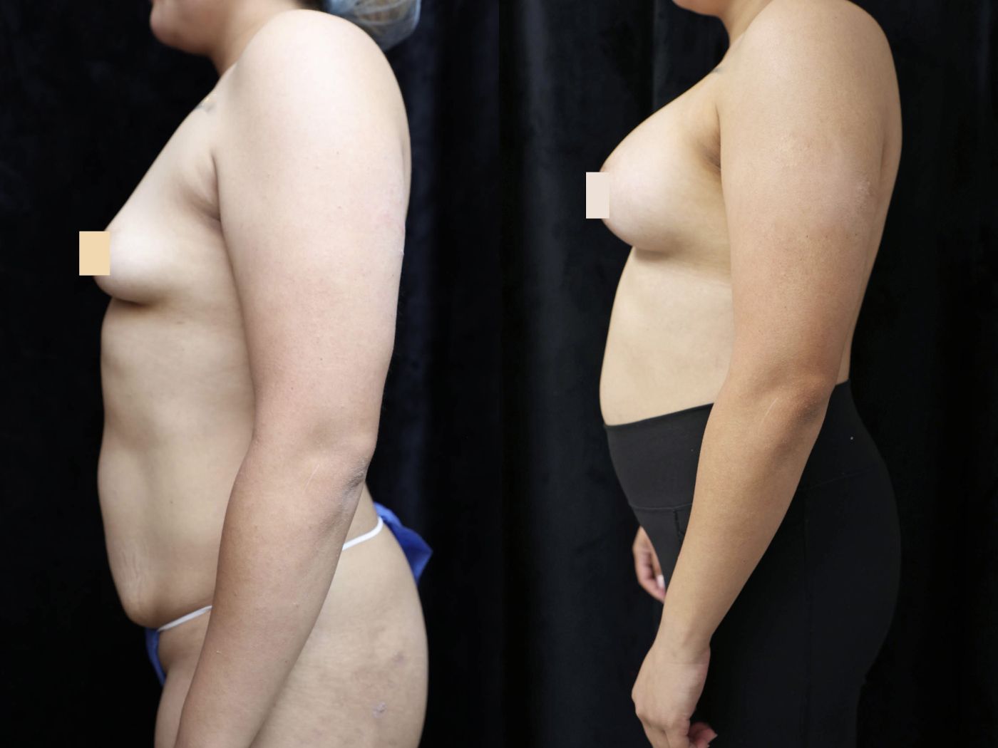 Breast Augmentation Before & After Photos