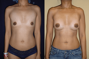 Breast Augmentation Before & After Photos