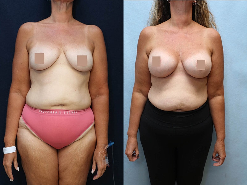 Breast Augmentation Before & After Photos