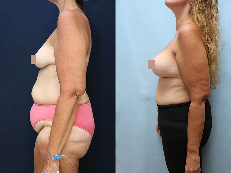 Breast Augmentation Before & After Photos