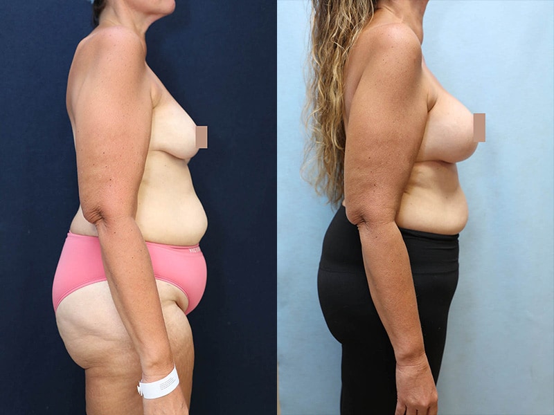 Breast Augmentation Before & After Photos