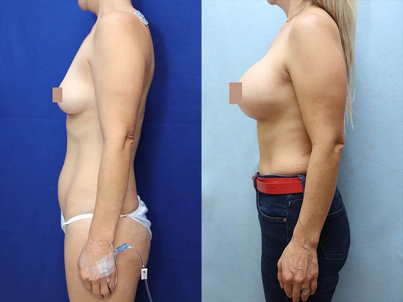 Breast Augmentation Before & After Photos