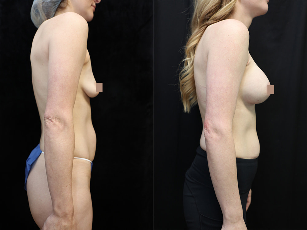 Breast Augmentation Before & After Photos