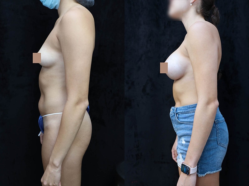 Breast Augmentation Before & After Photos