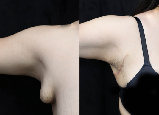 Breast Augmentation Before & After Photos