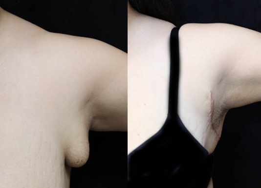 Breast Augmentation Before & After Photos