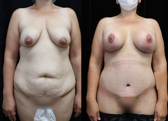 Breast Augmentation Before & After Photos