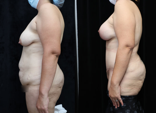 Breast Augmentation Before & After Photos