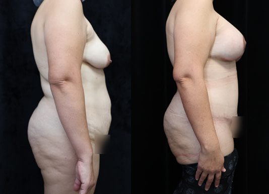 Breast Augmentation Before & After Photos