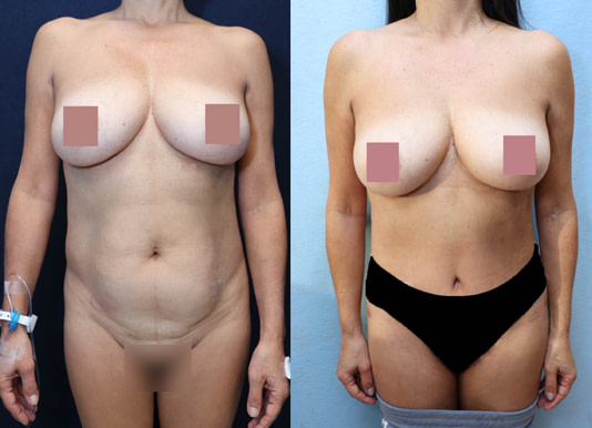 Breast Augmentation Before & After Photos