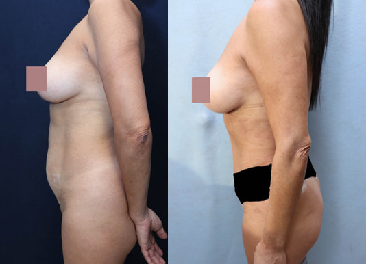 Breast Augmentation Before & After Photos