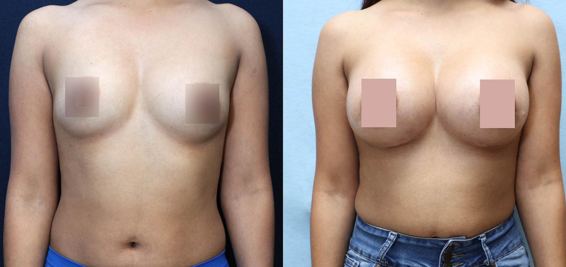 Breast Augmentation Before & After Photos