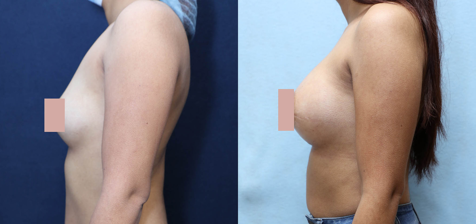 Breast Augmentation Before & After Photos