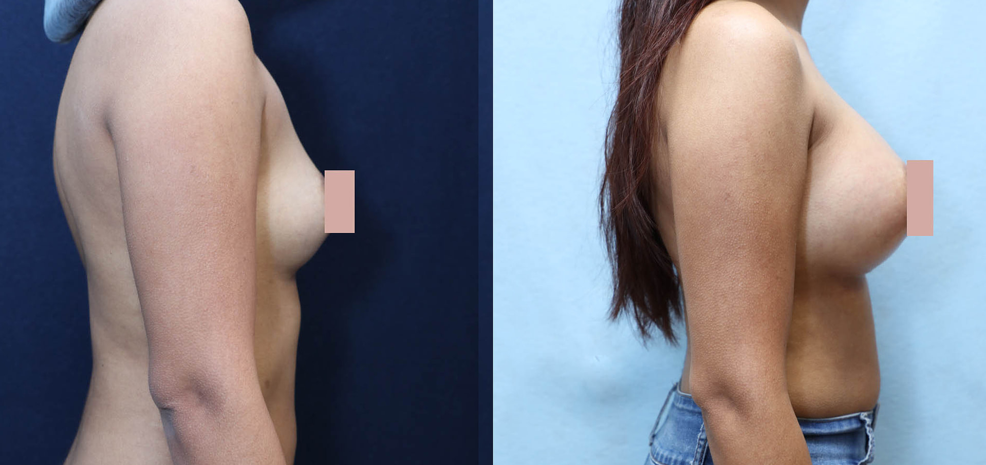 Breast Augmentation Before & After Photos