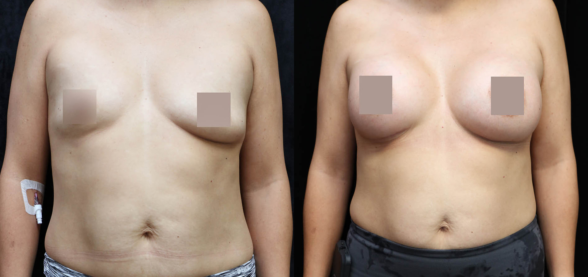 Breast Augmentation Before & After Photos