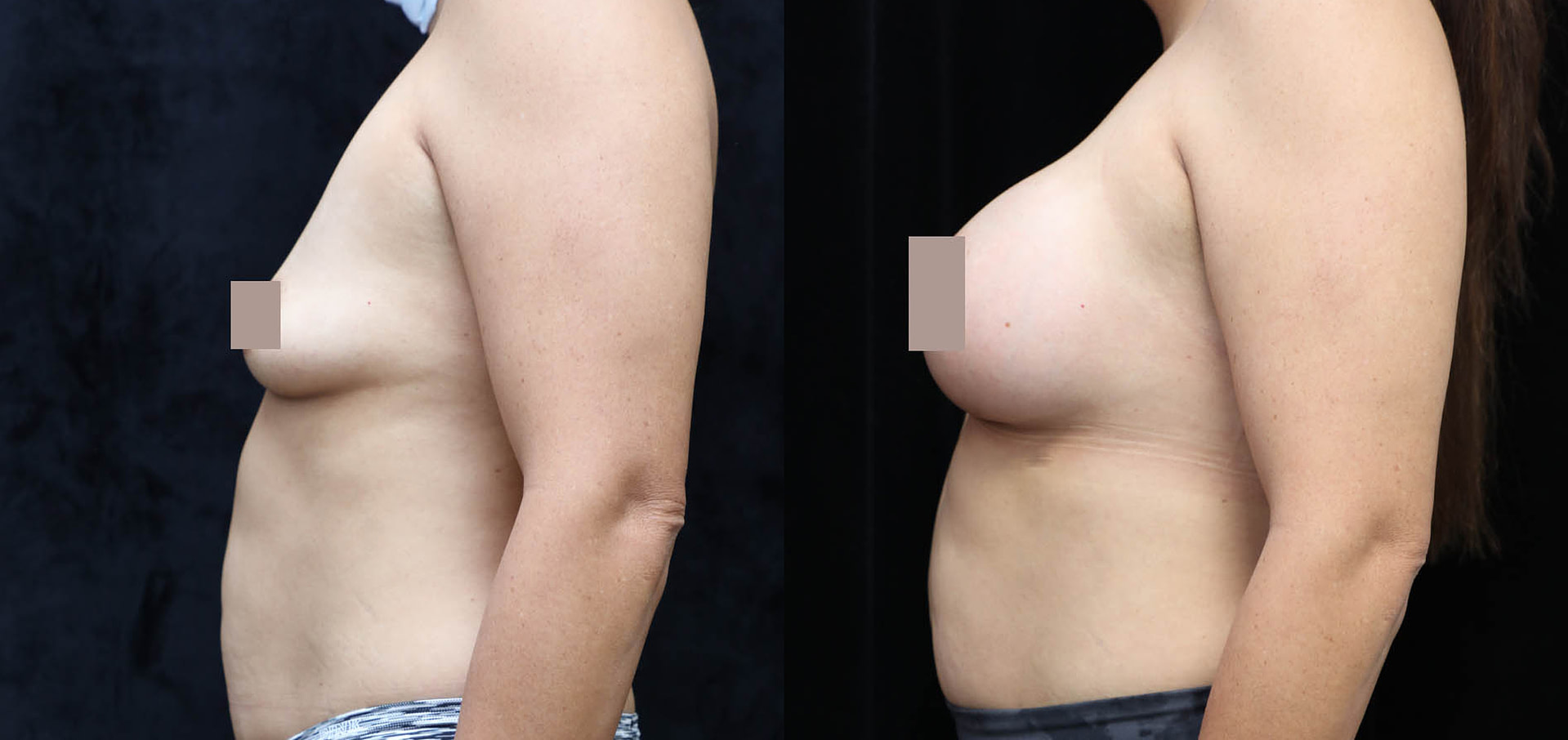 Breast Augmentation Before & After Photos