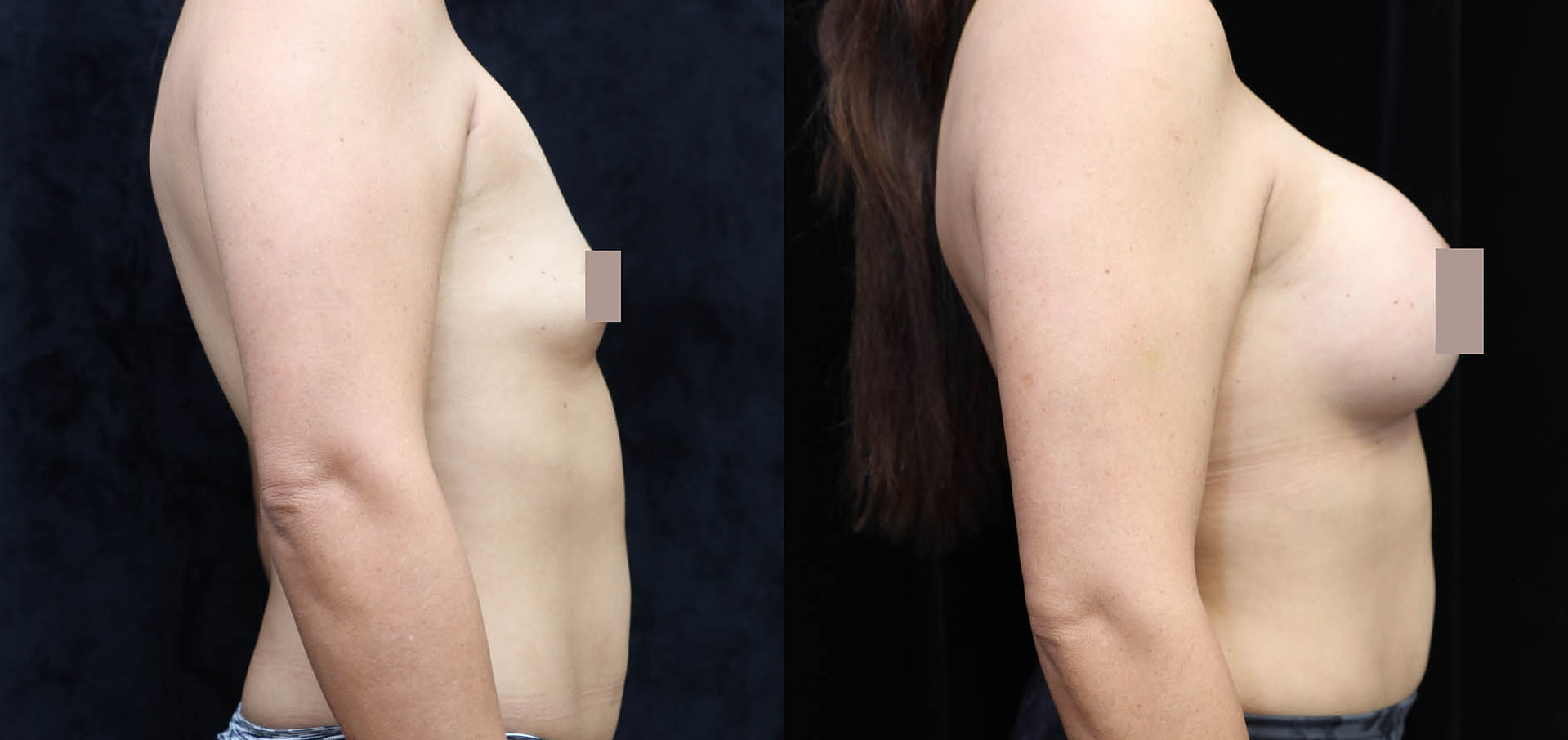 Breast Augmentation Before & After Photos