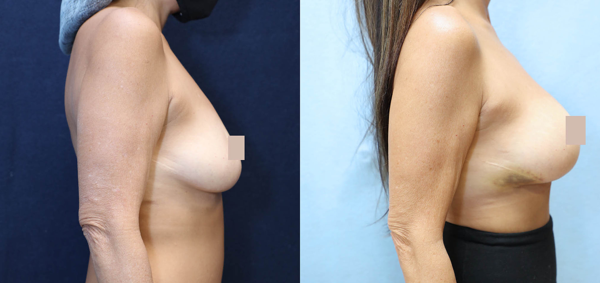 Breast Augmentation Before & After Photos