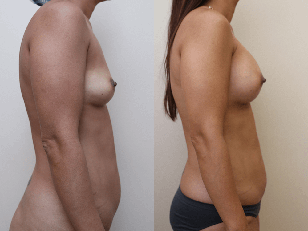 Breast Augmentation Before & After Photos Right Side