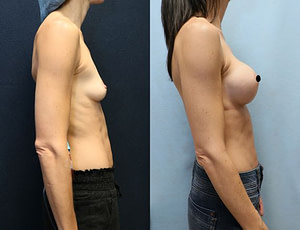 breast augmentation before and after right