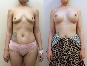 Breast Augmentation front