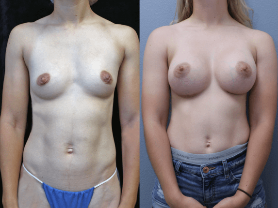Breast Augmentation Before & After Photos Front Side