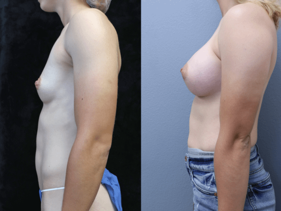 Breast Augmentation Before & After Photos Left Side