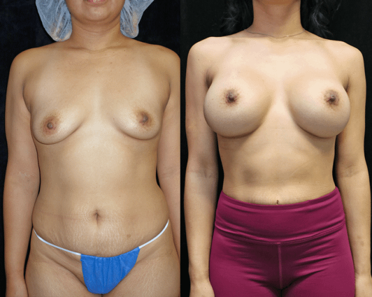 breast augmentation before and after photos - front