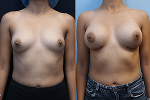 breast augmentation before and after photos - front