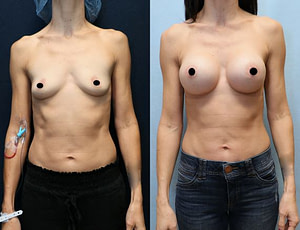 breast augmentation before and after front