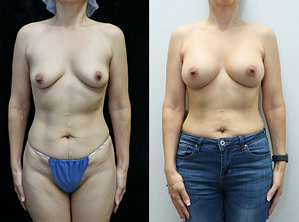 brast augmentatin front before and after results