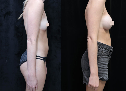 Breast Augmentation Before & After Photos
