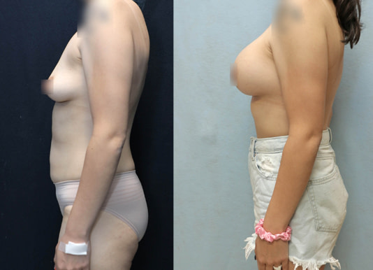 Breast Augmentation Before & After Photos
