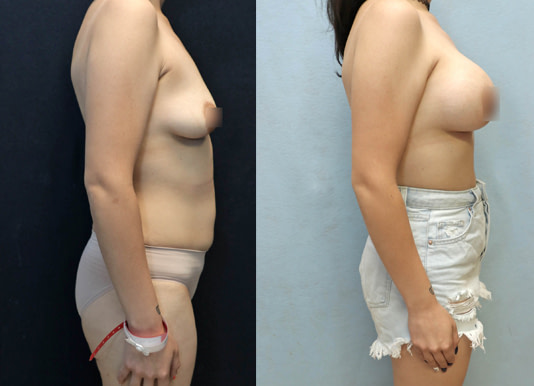 Breast Augmentation Before & After Photos