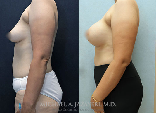 breast augmentation before and after left