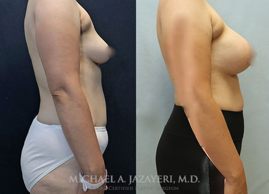breast augmentation before and after right