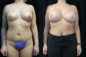 breast augmentation before and after front
