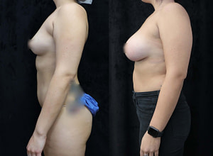 breast augmentation before and after facing left