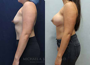 bilateral breast augmentation before and after