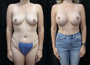 Breast implant before and after
