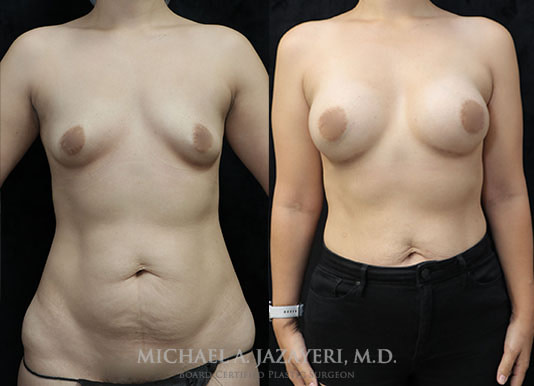 breast augmentation before and after
